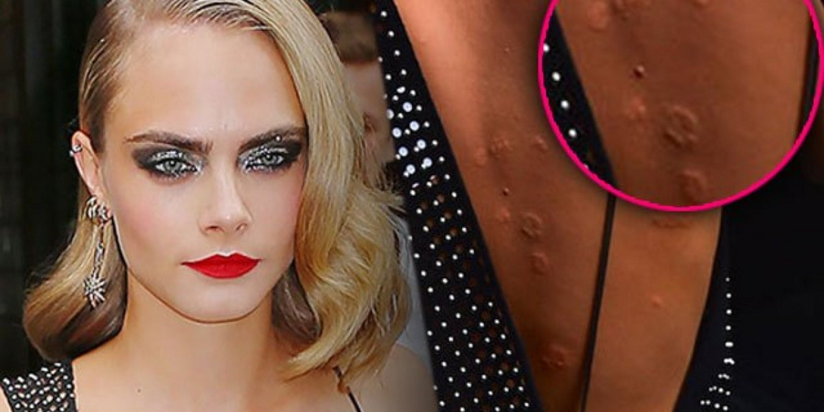 Родинки у кары делевинь - фото презентация, Кара Делевинь слив, Cara Delevingne сливы.