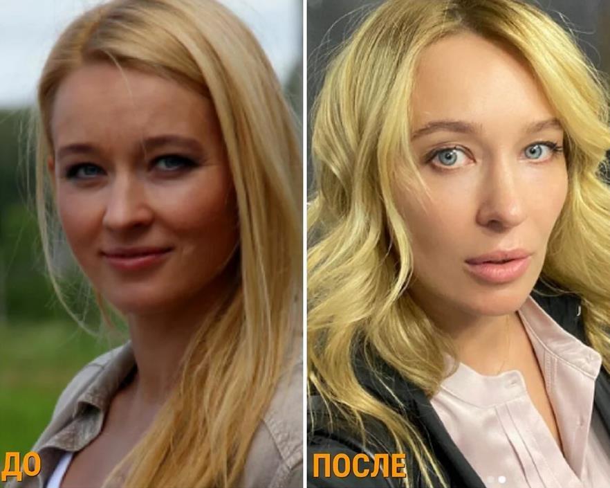 Ещё одна подборка снимков Насти до и после пластики.