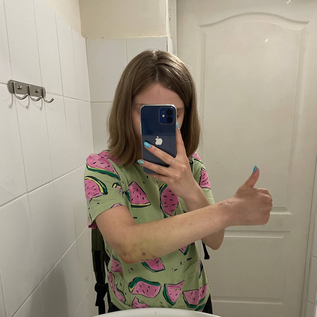 Попавшее в сеть селфи Али с травмированным локтём.