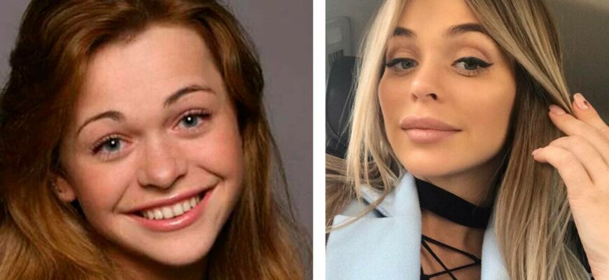 30 Фото Анны Хилькевич до и после пластики