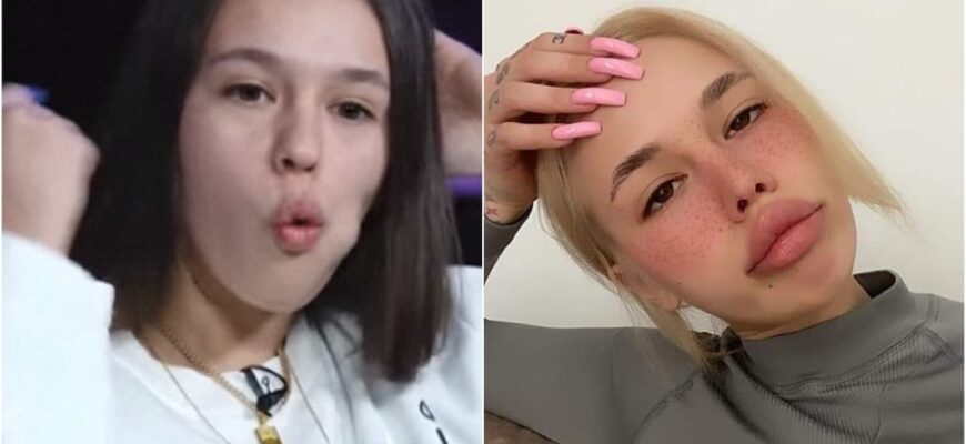 Инстасамка 30 фото До и После Пластики